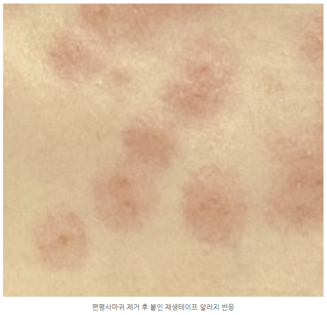 부산 편평사마귀 레이저 제거_06.png