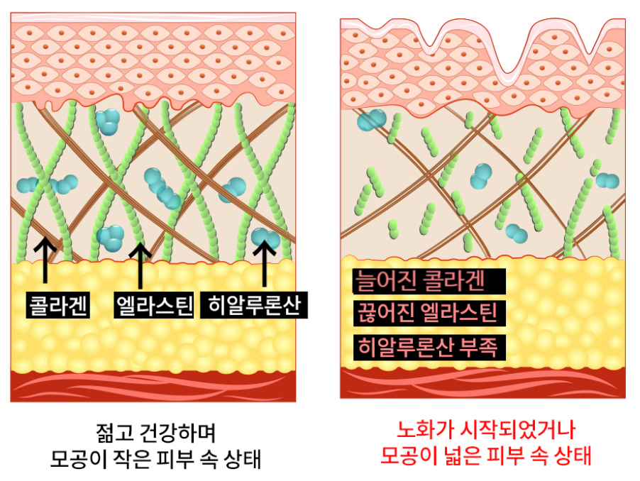 부산 해운대 센텀_코 나비존 모공축소_03.jpg