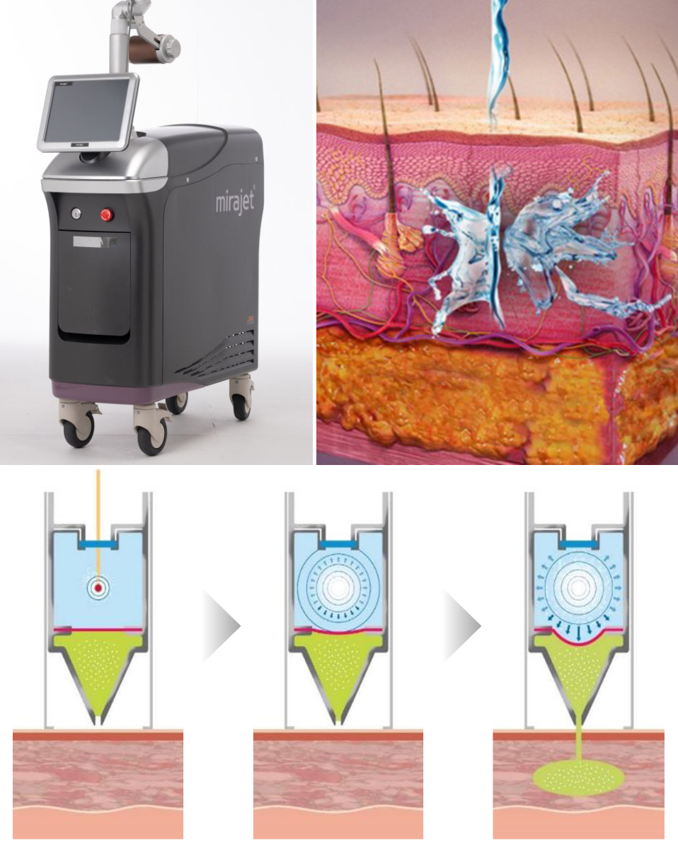 부산 해운대 센텀_코 나비존 모공축소_05.jpg