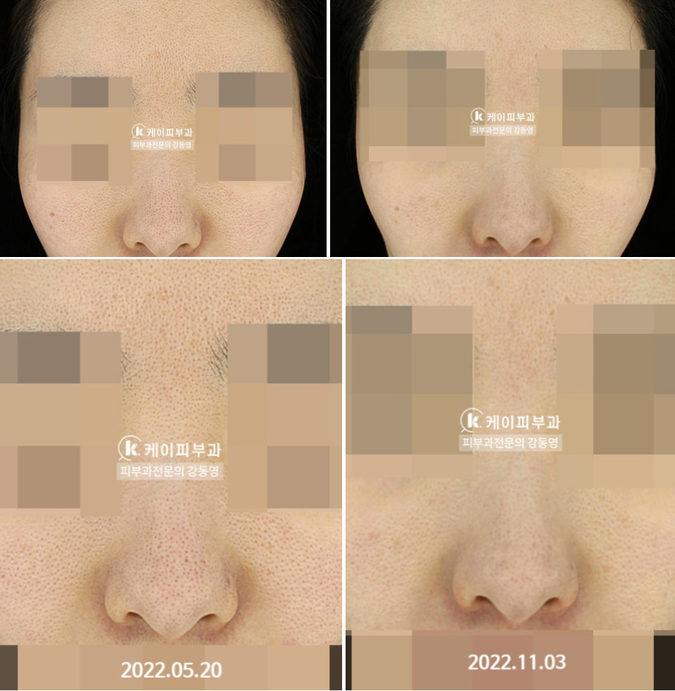 부산 해운대 센텀_코 나비존 모공축소_04.jpg