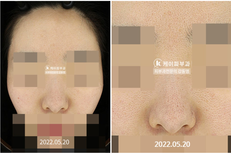 부산 해운대 센텀_코 나비존 모공축소_02.jpg