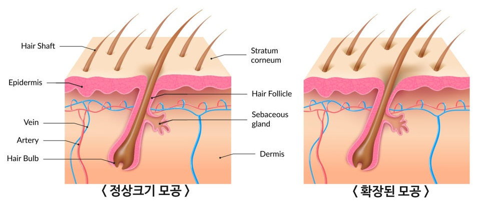 부산 해운대 센텀_코 나비존 모공축소_01.jpg
