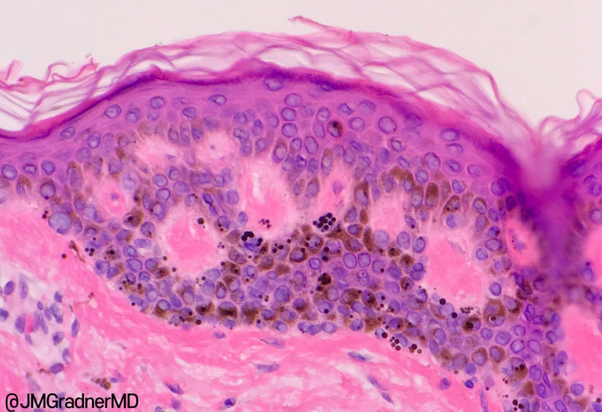부산 갈색반점 밀크커피반점 제거 치료_02.jpg