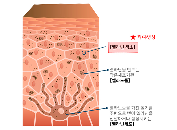 부산 갈색반점 밀크커피반점 제거 치료_04.jpg