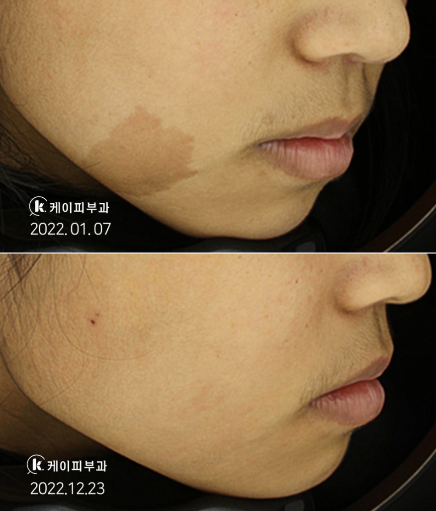 부산 갈색반점 밀크커피반점 제거 치료_01.jpg