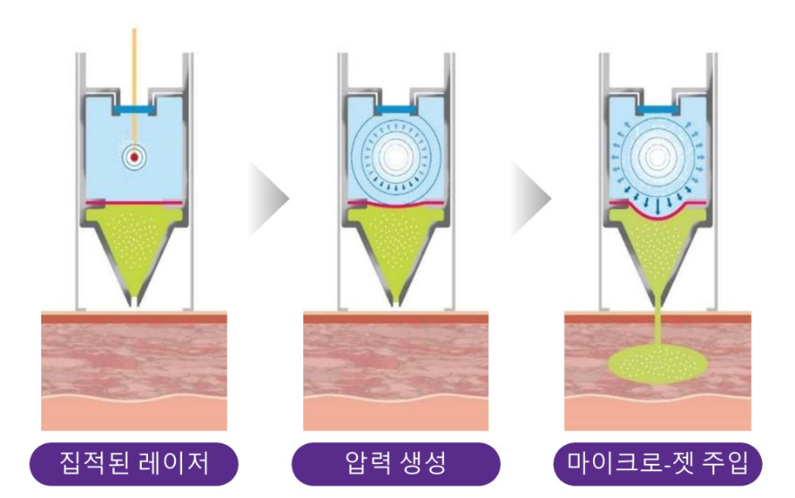 케이피부과_미라젯_원리.png