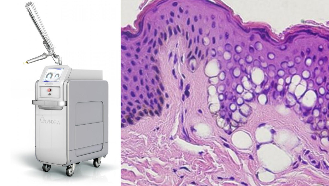 켈로이드흉터 치료 레이저 효과_05.jpg