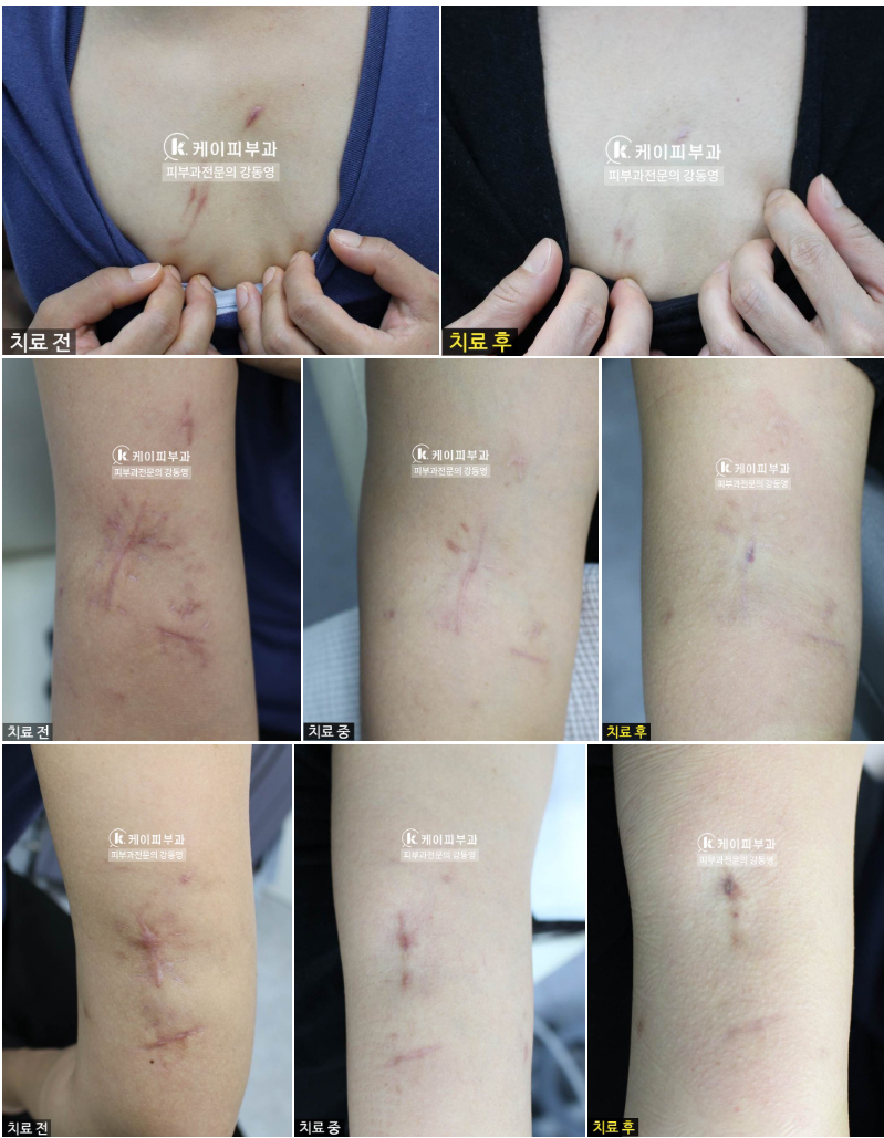 켈로이드흉터 치료 레이저 효과_02.jpg