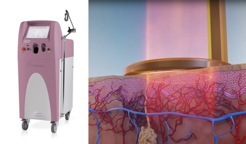 켈로이드흉터 치료 레이저 효과_03.jpg
