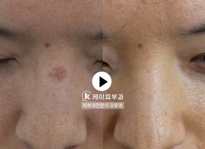 켈로이드흉터 치료 레이저 효과_04.jpg