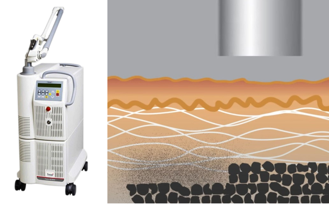 켈로이드흉터 치료 레이저 효과_06.jpg