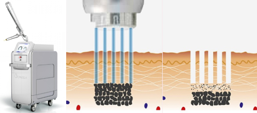 부산 기미잡티제거 복합 레이저토닝_05.jpg