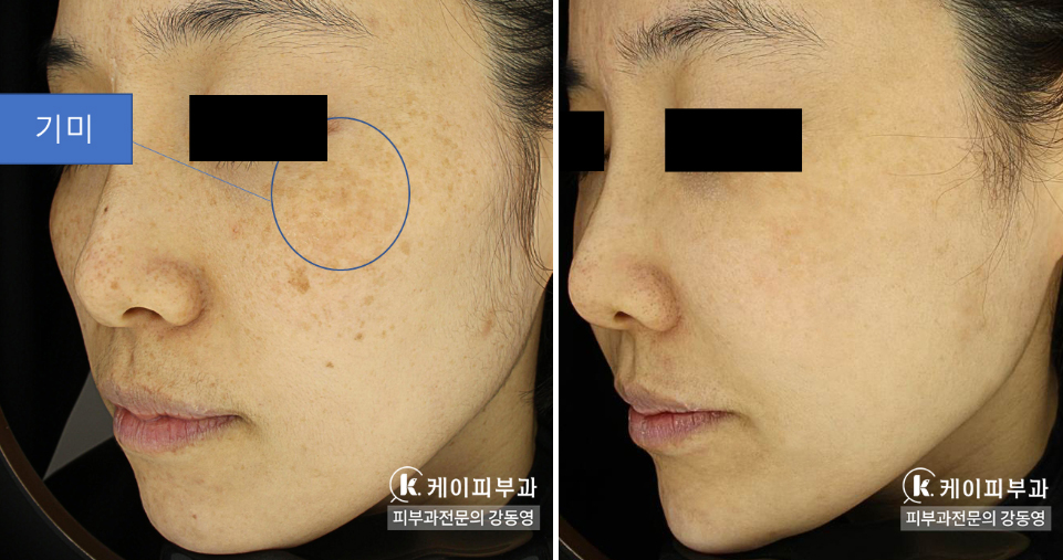 부산 기미잡티제거 복합 레이저토닝_07.jpg