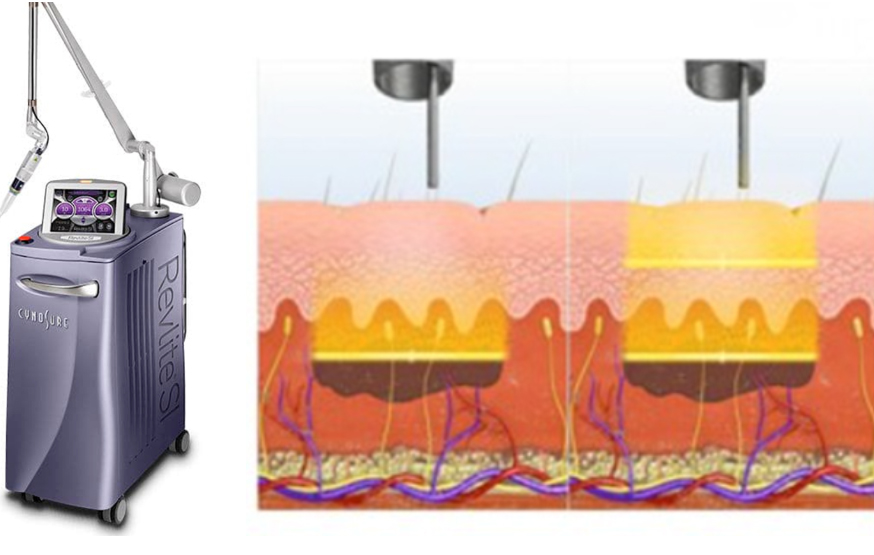 부산 기미잡티제거 복합 레이저토닝_03.jpg