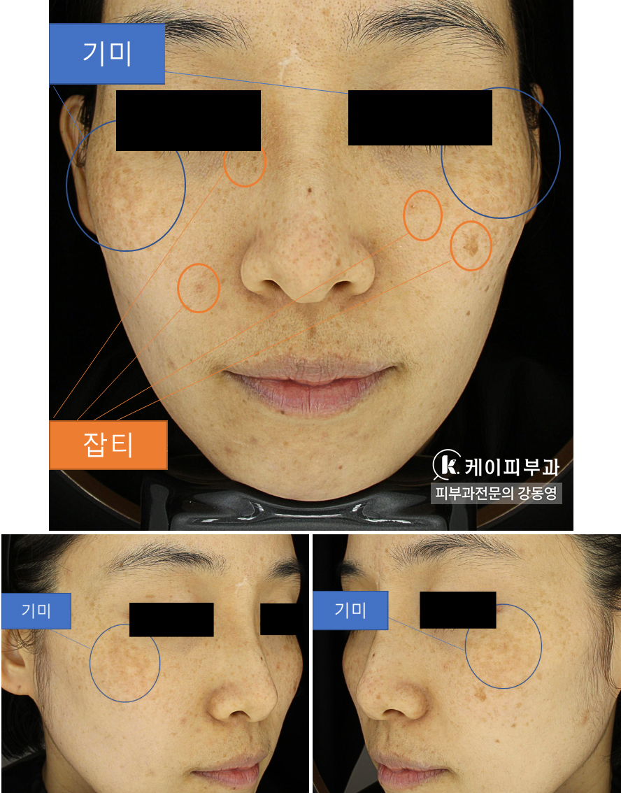 부산 기미잡티제거 복합 레이저토닝_01.jpg