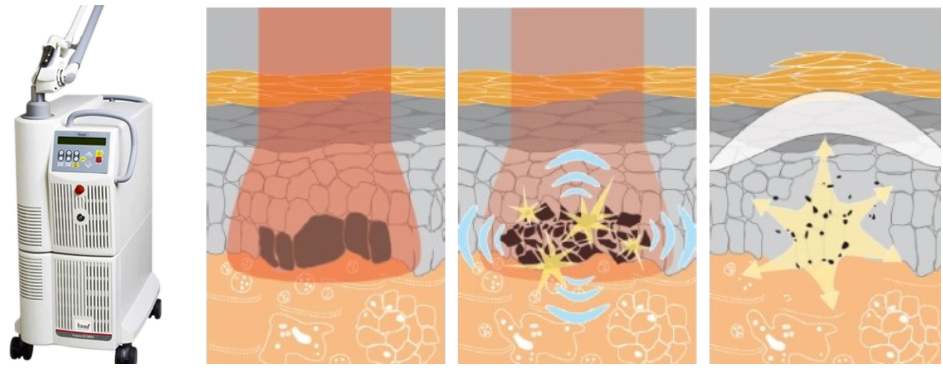 부산 기미잡티제거 복합 레이저토닝_04.jpg