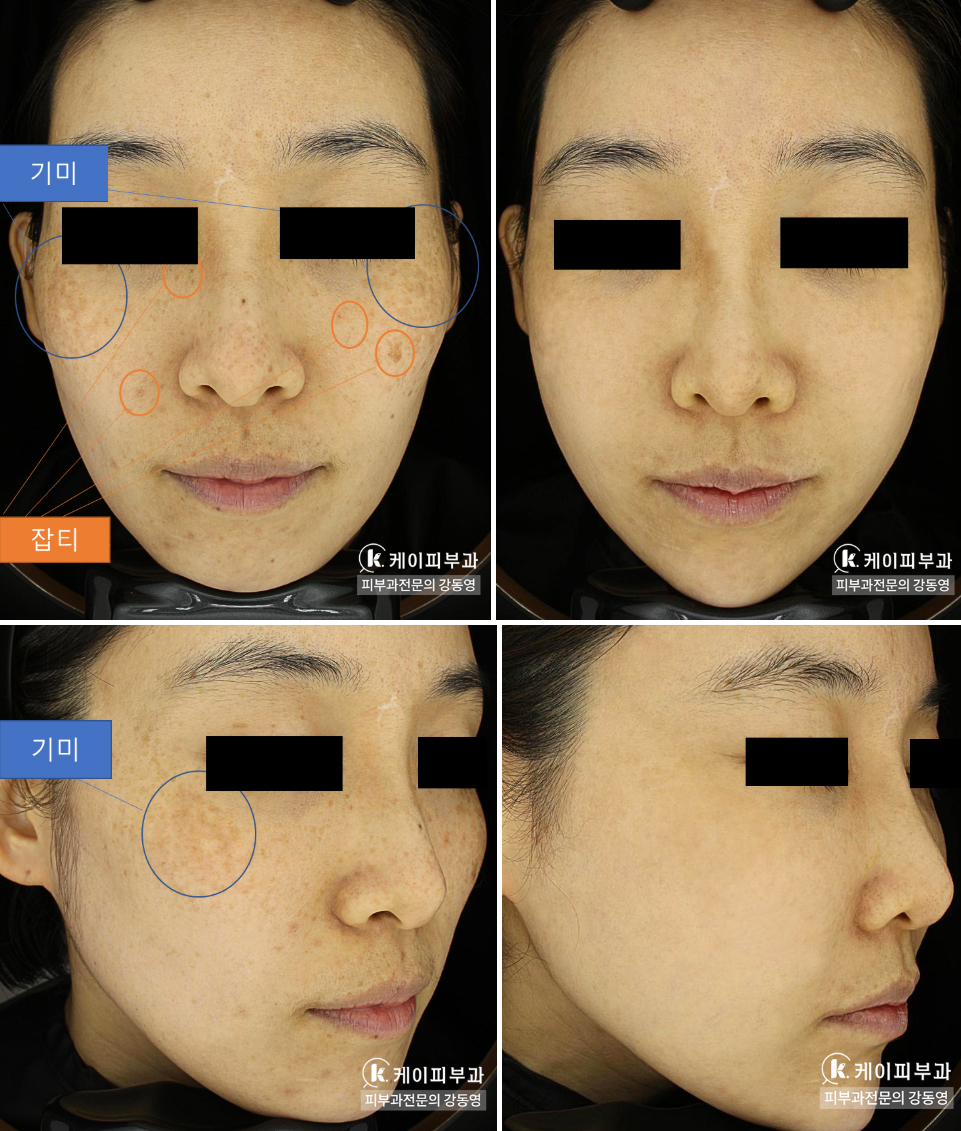 부산 기미잡티제거 복합 레이저토닝_06.jpg