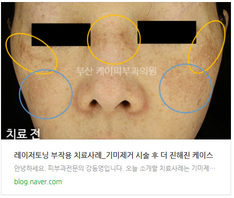 부산 해운대 기미 레이저토닝(피코토닝) _07.jpg