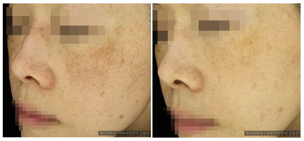 부산 해운대 기미 레이저토닝(피코토닝) _06.jpg