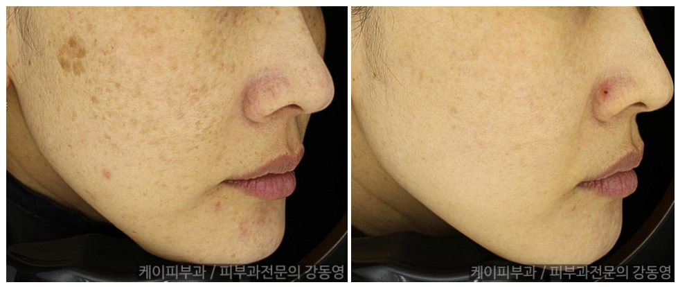 부산 해운대 기미 레이저토닝(피코토닝) _04.jpg