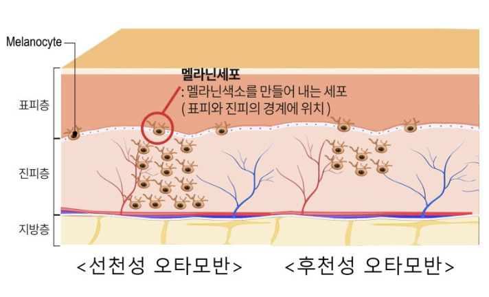 부산 선천성 오타모반 레이저 제거_01.png