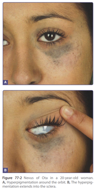 부산 선천성 오타모반 레이저 제거_03.png