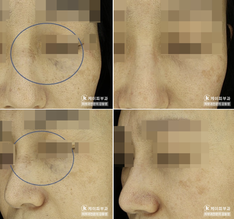 부산 선천성 오타모반 레이저 제거_04.png