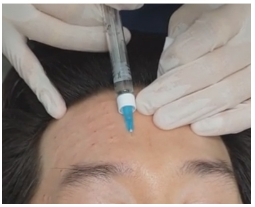 리쥬란힐러 손주사 VS 리쥬메이트 시술_02.jpg