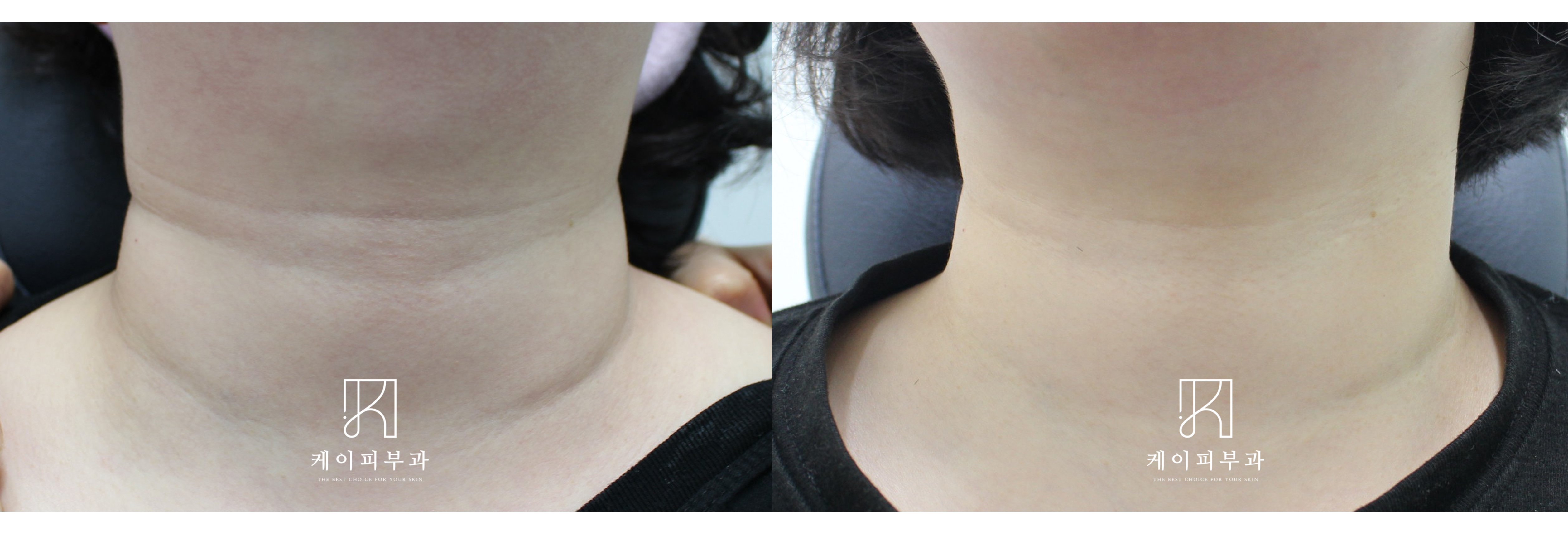부산 목주름 제거_레이저 필러 보톡스_03.jpg