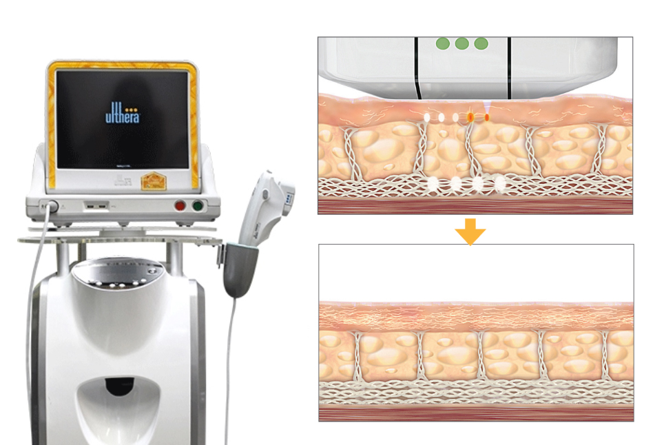 부산 목주름 제거_레이저 필러 보톡스_07.jpg