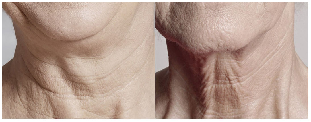 부산 목주름 제거_레이저 필러 보톡스_01.jpg