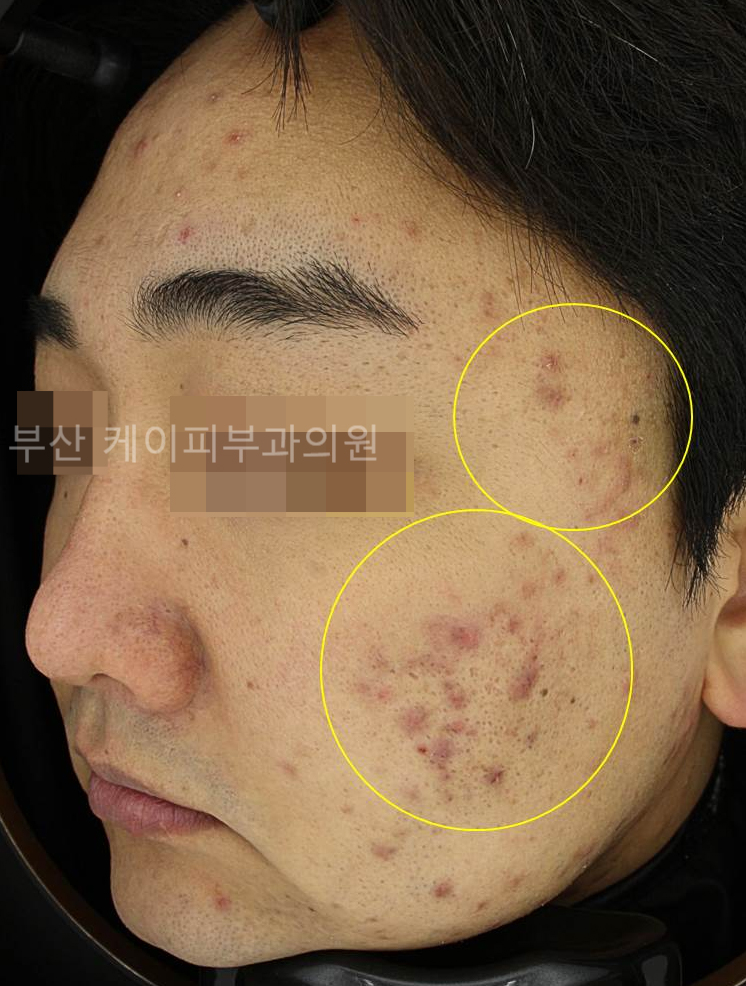 고주파 여드름자국 포텐자 브이빔퍼펙타_01.jpg