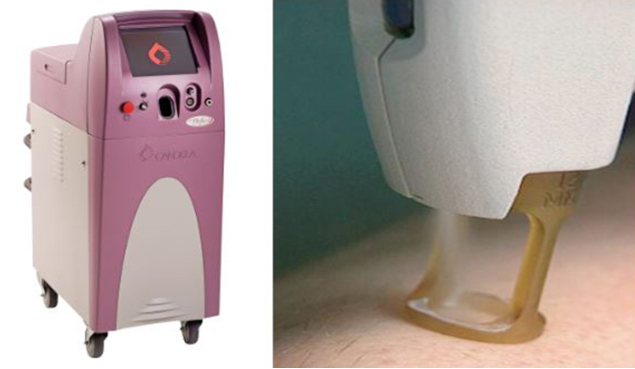 고주파 여드름자국 포텐자 브이빔퍼펙타_05.jpg