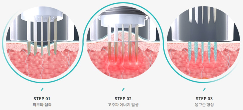 고주파 여드름자국 포텐자 브이빔퍼펙타_04.jpg