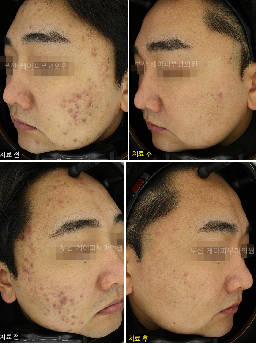 고주파 여드름자국 포텐자 브이빔퍼펙타_02.jpg