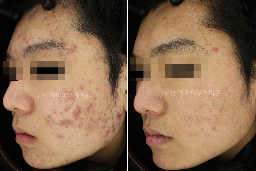 부산 심한 여드름 치료 후기_04.jpg
