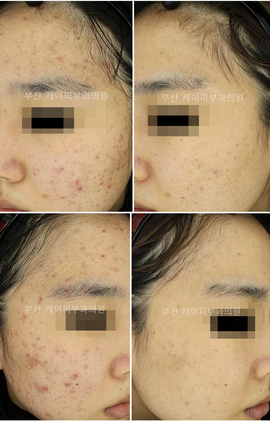 부산 심한 여드름 치료 후기_07.jpg