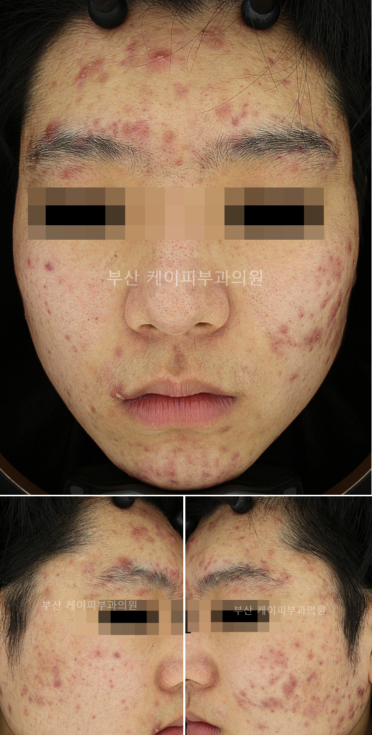 부산 심한 여드름 치료 후기_02.jpg