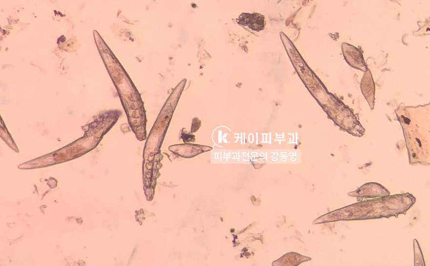 부산 여드름치료_여드름약 종류 및 부작용_04.jpg