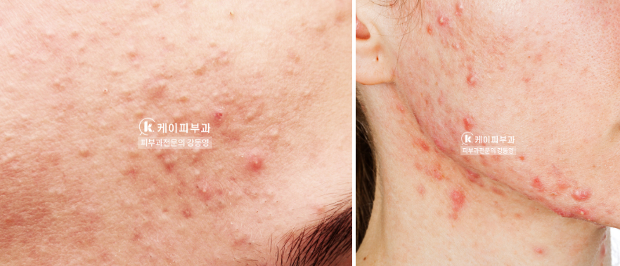 부산 여드름치료_여드름약 종류 및 부작용_03.jpg