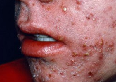 부산 여드름치료_여드름약 종류 및 부작용_06.jpg