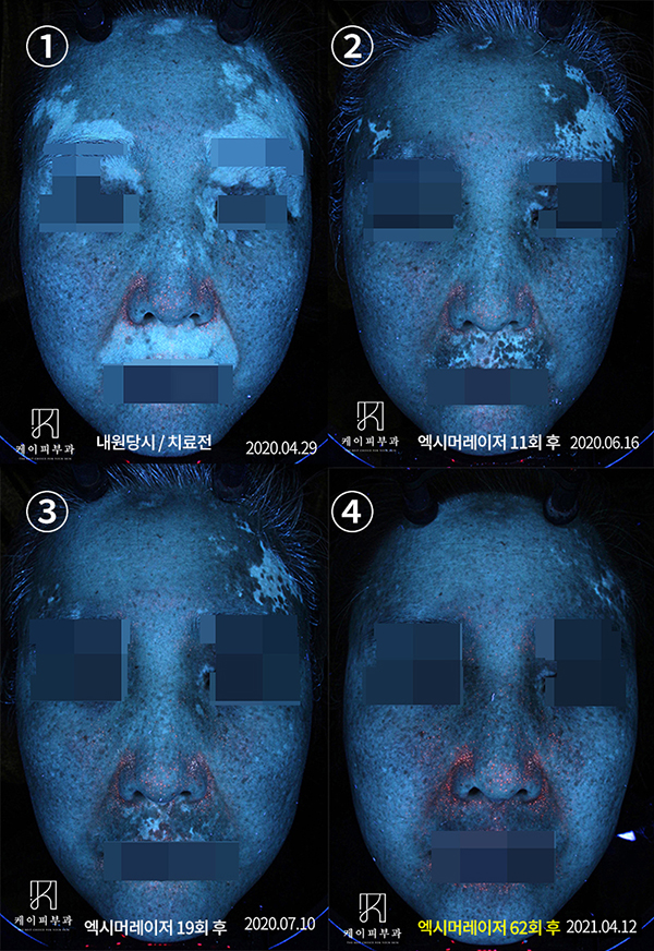 부산-백반증치료-엑시머레이저-자외선치료기_12.jpg