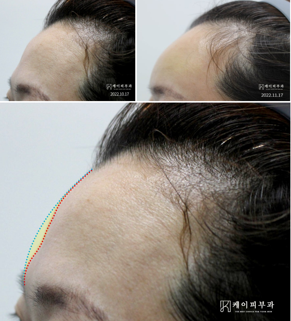 부산 이마필러 시 눈썹뼈 돌출_02.jpg