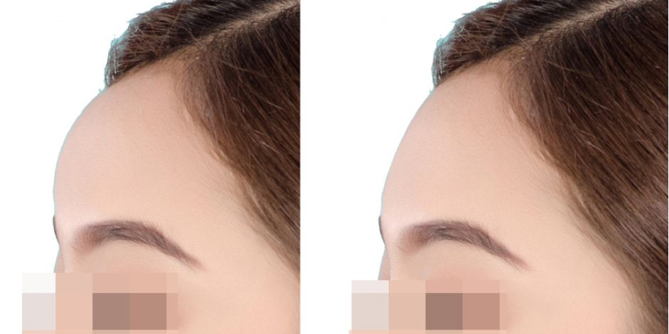부산 이마필러 시 눈썹뼈 돌출_03.jpg
