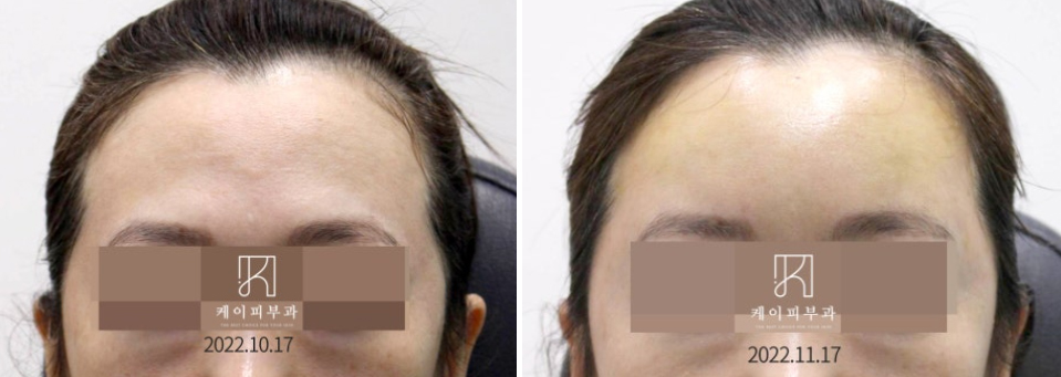 부산 이마필러 시 눈썹뼈 돌출_04.jpg