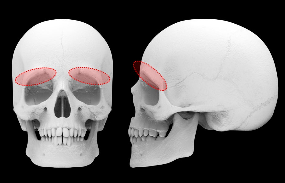 부산 이마필러 시 눈썹뼈 돌출_01.jpg