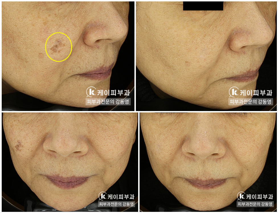 부산 레이저 부작용 색소침착 _04.jpg