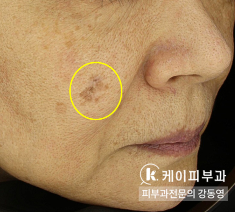 부산 레이저 부작용 색소침착 _01.jpg
