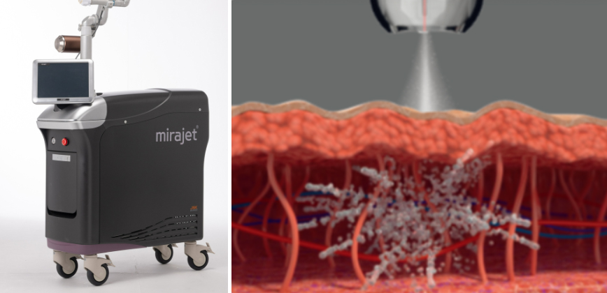 부산 해운대 센텀 튼살레이저 치료_07.jpg