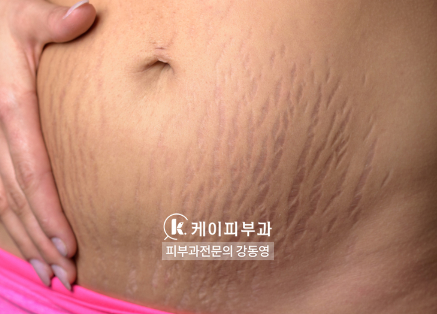 부산 해운대 센텀 튼살레이저 치료_01.jpg